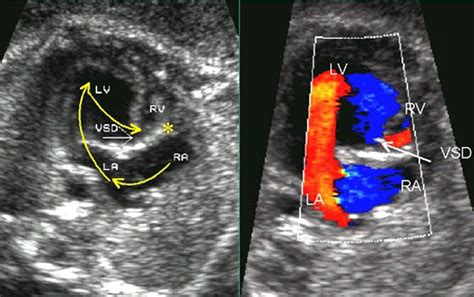 Color Doppler Sonography In Assessment Of The Fetal Heart Sonography