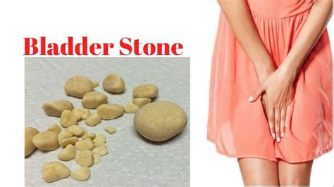 What Do Bladder Stones Look Like