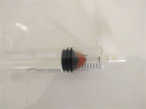 About 08 Ml Of A Brown Secretion Was Aspirated From The Cyst Of The