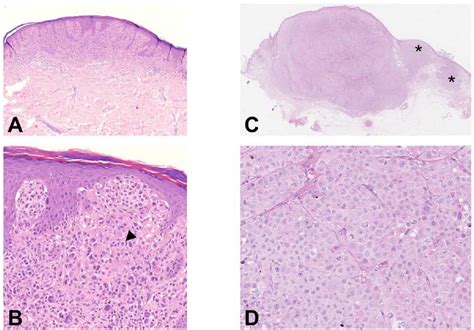 Figure 1 From Histologic Features Of Melanoma Associated With Germline