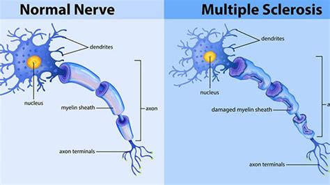 Temperature Sensitivity In Multiple Sclerosis Causes Symptoms And