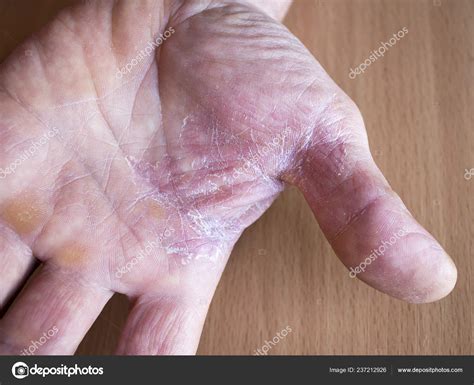 Peeling Dry Skin Hands Concept Treatment Prevention Skin Diseases