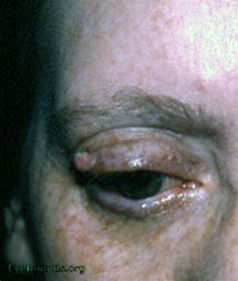 Papilloma Of Lid Online Ophthalmic Atlas