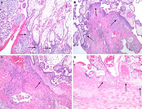 Defense And Infection Of The Human Placenta Heerema‐mckenney 2018