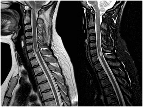 La resonancia magnética (rm) es una herramienta de diagnóstico y seguimiento por imagen de vital importancia para la evaluación de los pacientes con esclerosis múltiple (em). Mielitis transversa por vacunación