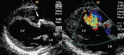 Principles Of Cardiovascular Ultrasound Thoracic Key