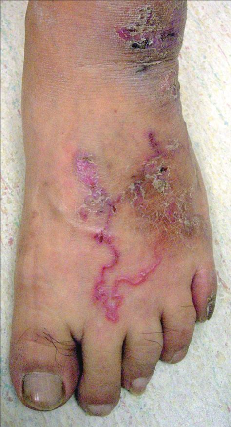 Cutaneous Larva Migrans Complicated By Löffler Syndrome Dermatology