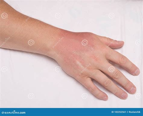 Sunburn Stock Image Image Of Sunburn Medical Hand 102252561