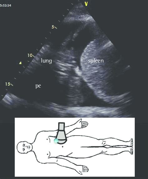 Ultrasound Identification Of Pleural Effusion At A Specific Site