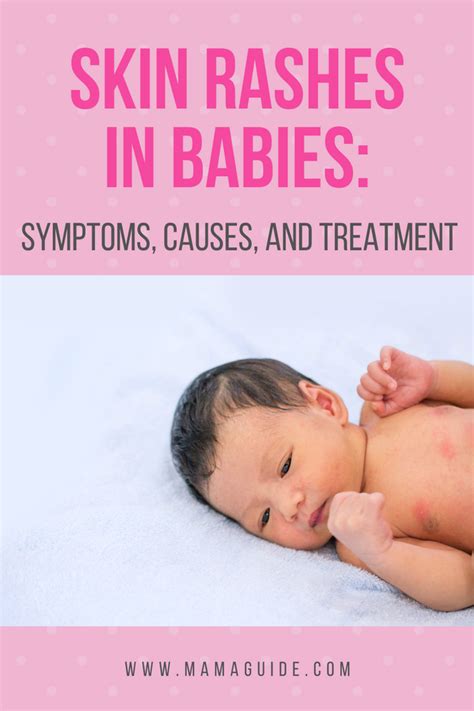 Baby Rashes Symptoms Causes Treatment Artofit