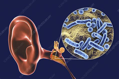 Otitis Media Ear Infection Illustration Stock Image F0326028