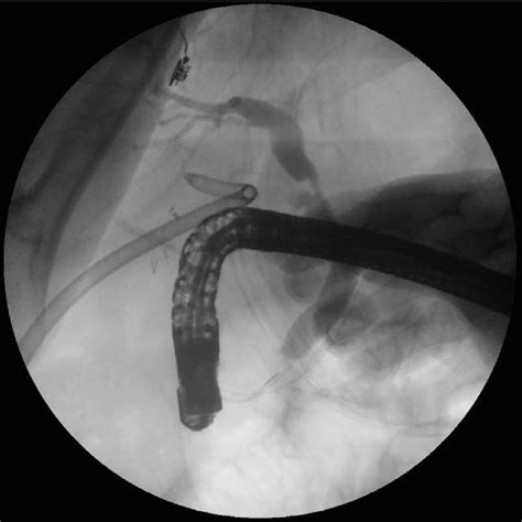 Radiographic View Of Conventional Ercp Performed After Antegrade