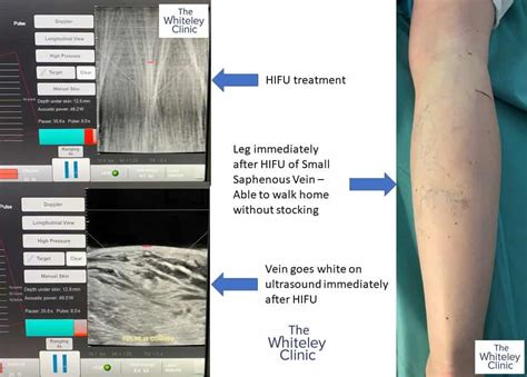 Varicose Vein Treated In 35 Minutes The Whiteley Clinic