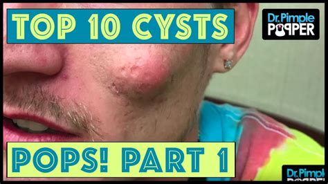 Dr Pimple Poppers Top 10 Cyst Pops Of 2017 Part 2 Pimple Popping Videos
