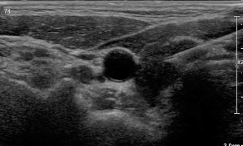 Thyroid Gland Ultrasound Showing The Right Lobe With Global