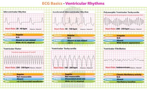 Ventricular Rhythms Ekg Interpretation Ecg Rhythms Nursing Mnemonics