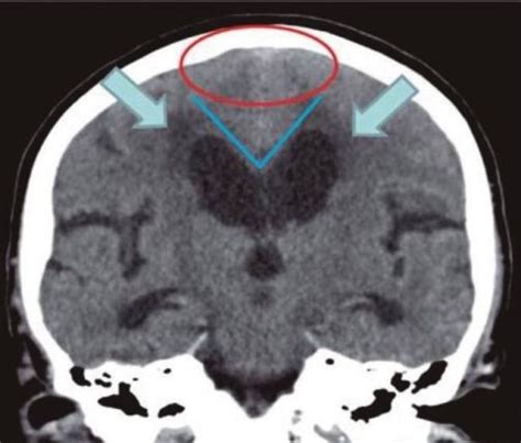 Normal Pressure Hydrocephalus Wikem