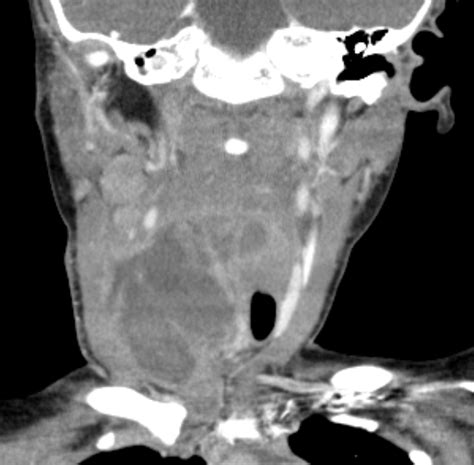 Infected 4th Branchial Cleft Cyst Image
