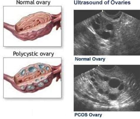 Ovarian Cysts Dr Elena Rodriguez