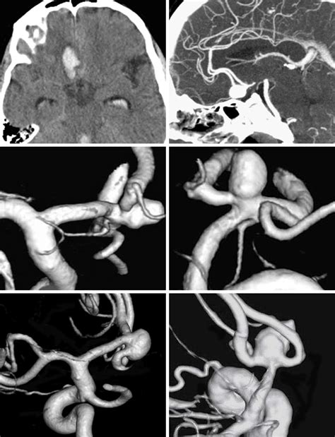 Anterior Communicating Artery Aneurysm The Neurosurgical Atlas