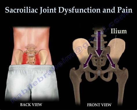 Sacroiliac Joint Dysfunction Animation Everything You Need To Know