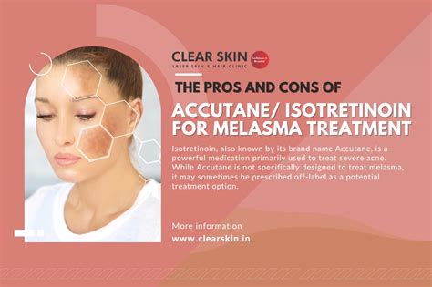 Pros And Cons Of Accutaneisotretinoin For Melasma Treatment