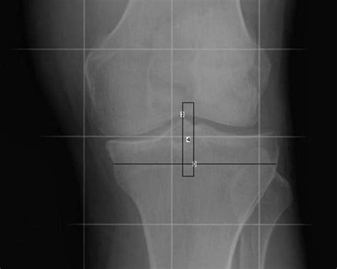 Lateral Tibio Femoral Shift Related To Medial Knee Osteoarthritis