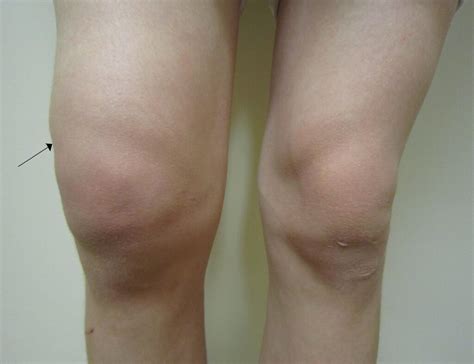 Obrzęk kolana opuchlizna kolana woda w kolanie przyczyny i