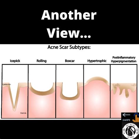 Types Of Acne Scars Overview My Acne Scars