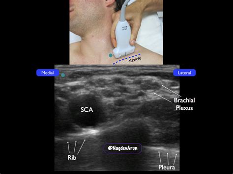 Supraclavicular Brachial Plexus Highland Em Ultrasound Fueled Pain