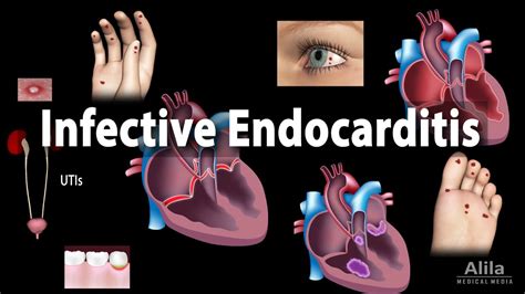 Can You Have Endocarditis Without A Fever All Answers