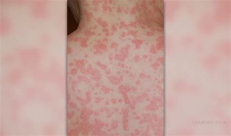 Allergic Reaction To Amoxicillin Allergies Articles Body And Health
