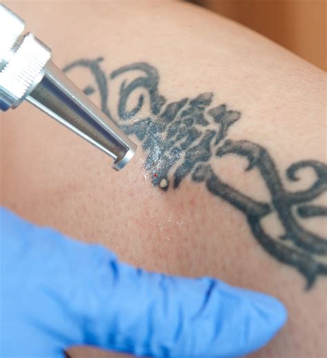 Laser Tattoo Removal In The Bay Area Essential Aesthetics