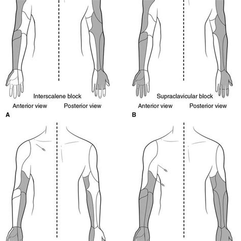 Pdf Brachial Plexus Blocks For Upper Extremity Orthopaedic Surgery