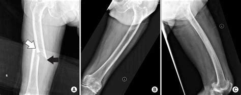 Surgical Treatment In Atypical Diaphyseal Femoral Fracture With