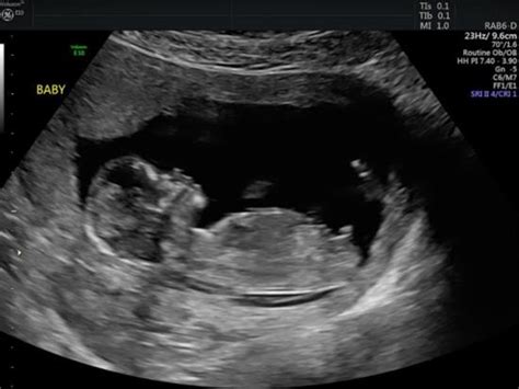 NUB THEORY- BOY OR GIRL?! 13 WEEK ULTRASOUND in Ultrasound ...