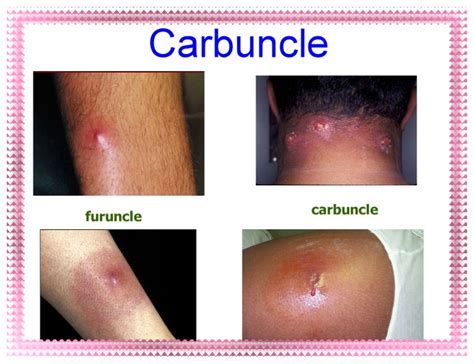 Фурункул и карбункул причины стадии симптомы лечение