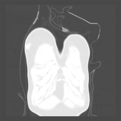 Hypoplastic Left Lung Image