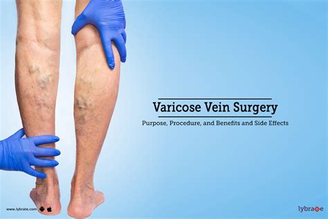 Varicose Veins Surgery Purpose Procedure Benefits And Side Effects