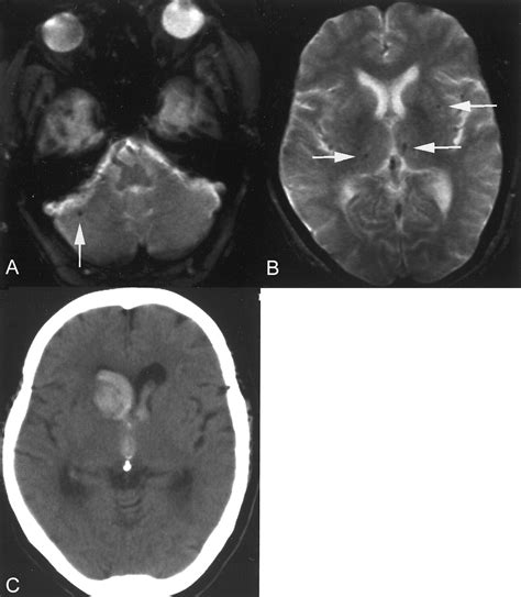 Brain Microhemorrhages Detected On T2 Weighted Gradient Echo Mr Images
