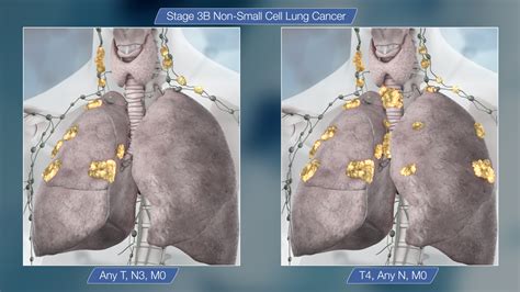 By stage 4, cancerous cells have spread beyond the lung where the cancer initially developed. Stage 3 Lung Cancer : All that you need to know ...