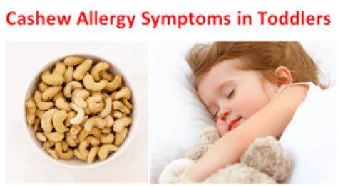 Cashew Allergy Symptoms Can Cashews Cause Allergies Fruits Facts