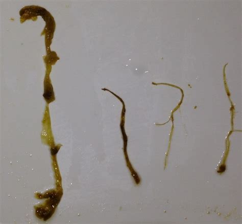 parasites in stool worm in stool 1 on curezone image gallery figures are not shown to scale