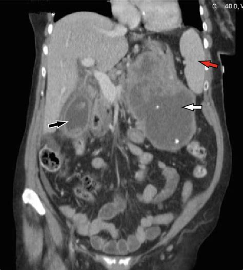 Contrast Enhanced Coronal Ct Scan Showing Distended Gallbladder With