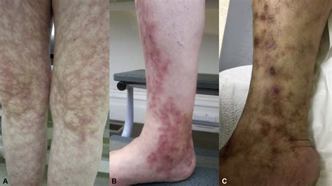 Lymphocytic Thrombophilic Arteritis And Cutaneous Polyarteritis Nodosa