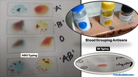 Blood Grouping And Rh Typing Introduction Principle Procedure