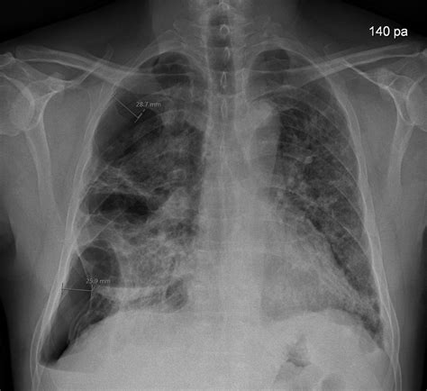Development Of Bullous Lung Disease In A Patient With Severe Covid 19