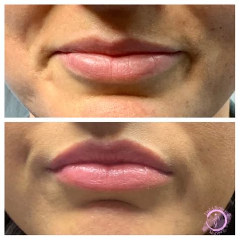 Botox Lip Flip Everything You Need To Know Find A Better You