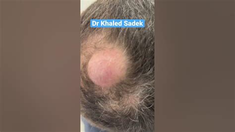 Massive Pilar Cyst Blackheads Shorts Skincare Dr Khaled Sadek Youtube