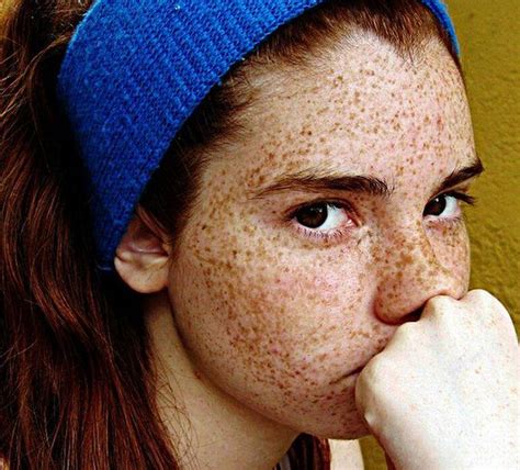 How To Make Freckles Go Away Skin Whitening Remedies